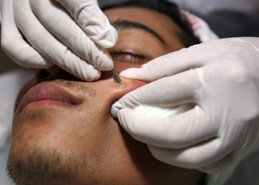 認清以下3點！杜絕草莓鼻再臨！