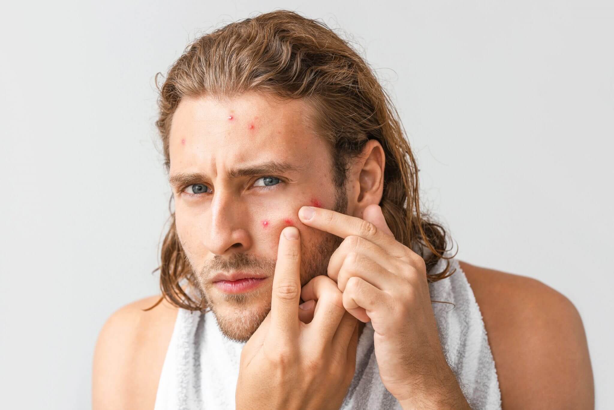 去粉刺前要先知：粉刺的種類？