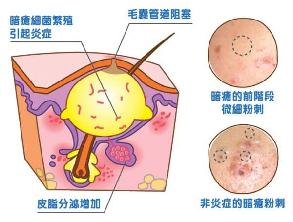 男士生暗瘡的病理機制