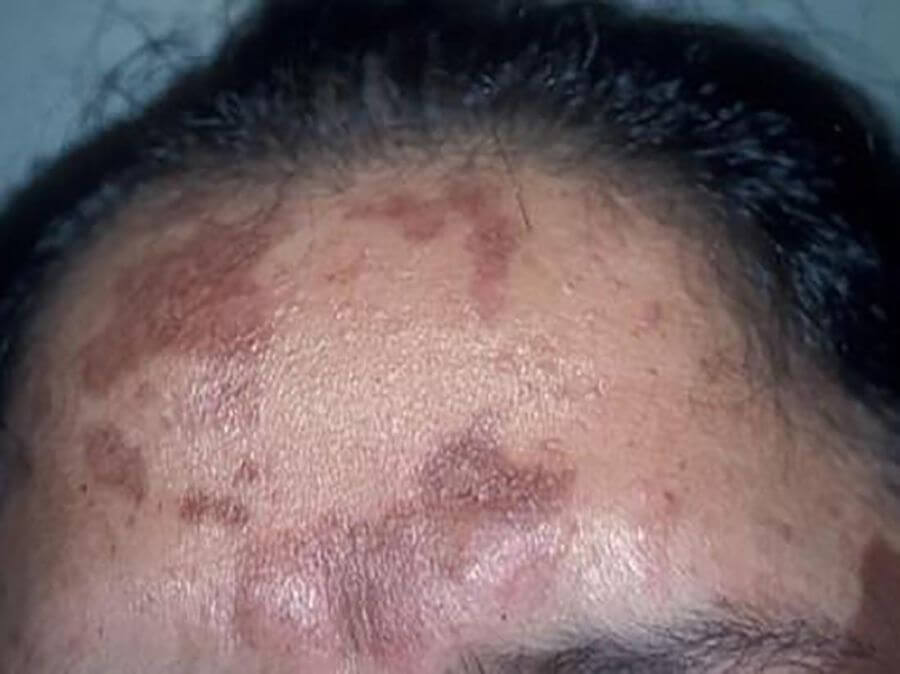 荷爾蒙斑是甚麼?