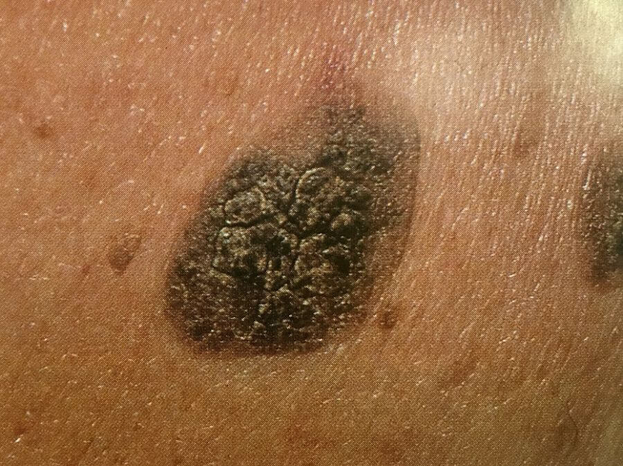 老人斑的成因是甚麼？