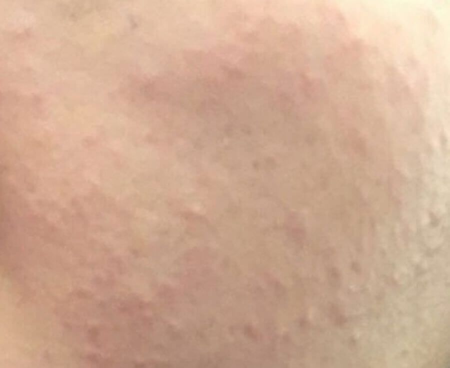 暗粒、油脂粒、暗瘡有甚麼分別?