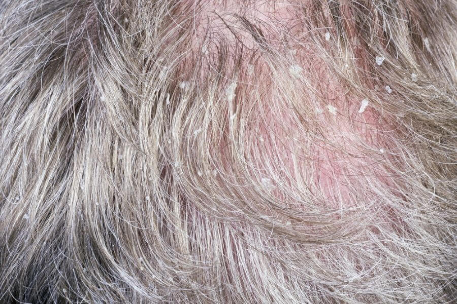 頭皮乾燥的徵狀