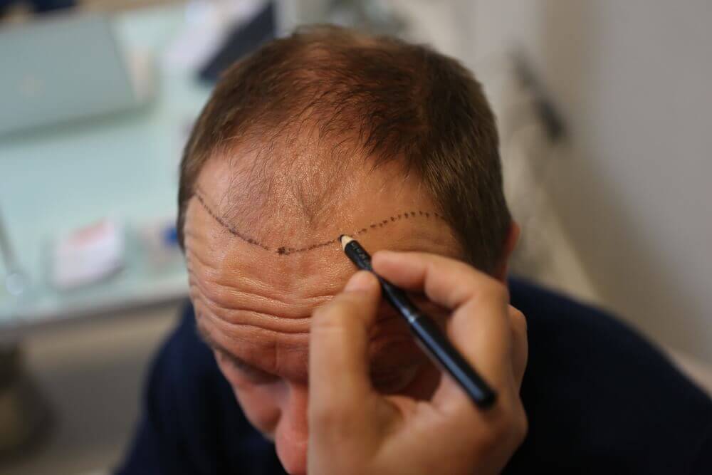 入侵性男士生髮療程