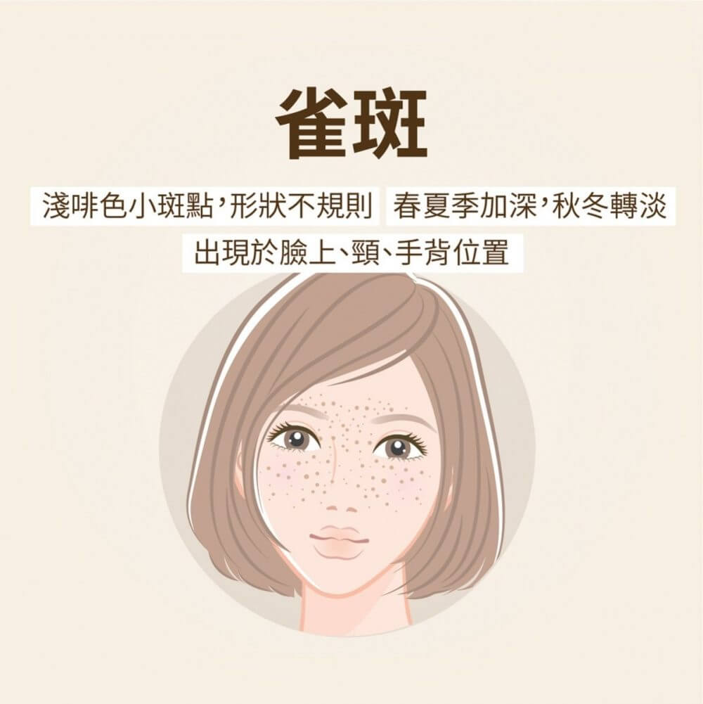 想美白去斑？色斑分為甚麼種類？