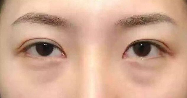 眼袋大是真是假?眼袋vs臥蠶vs淚溝的分別