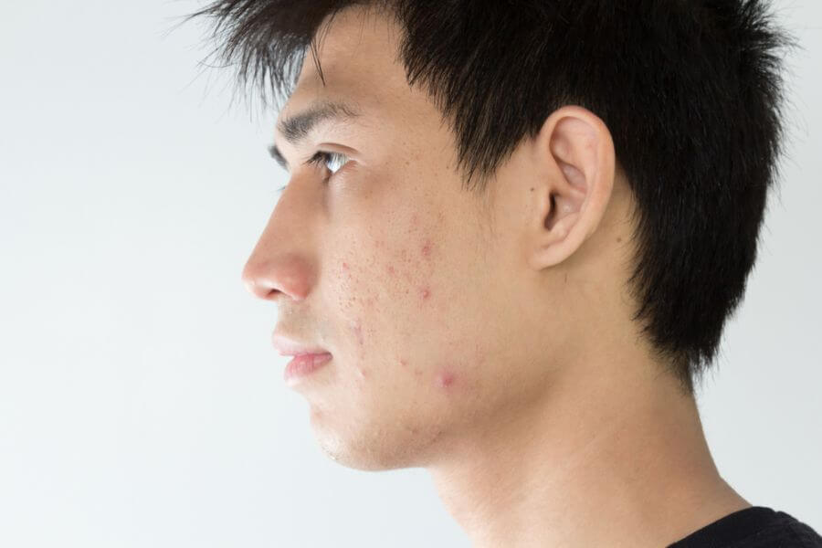 臉上/身體油脂粒的形成原因: