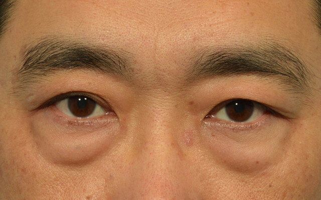 淚溝、眼袋、黑眼圈、臥蠶傻傻分不清?
