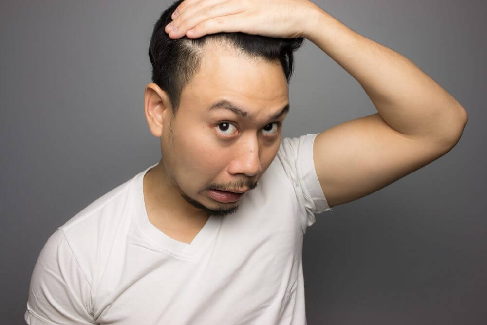 問：脫髮嚴重會變禿頭嗎