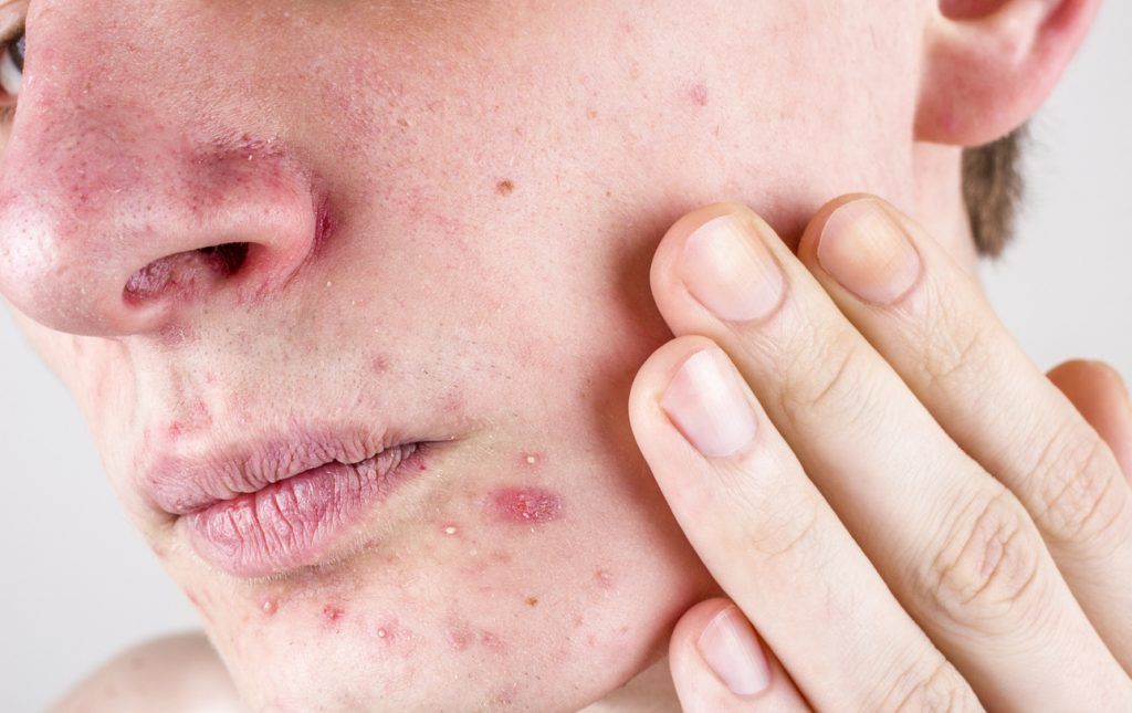 中醫：荷爾蒙失調源自心火旺、肝火旺及肝胃濕熱