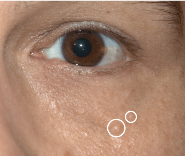 最常見的油脂粒—眼底的油脂粒