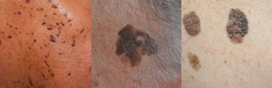 老人斑有機會演變成皮膚癌？