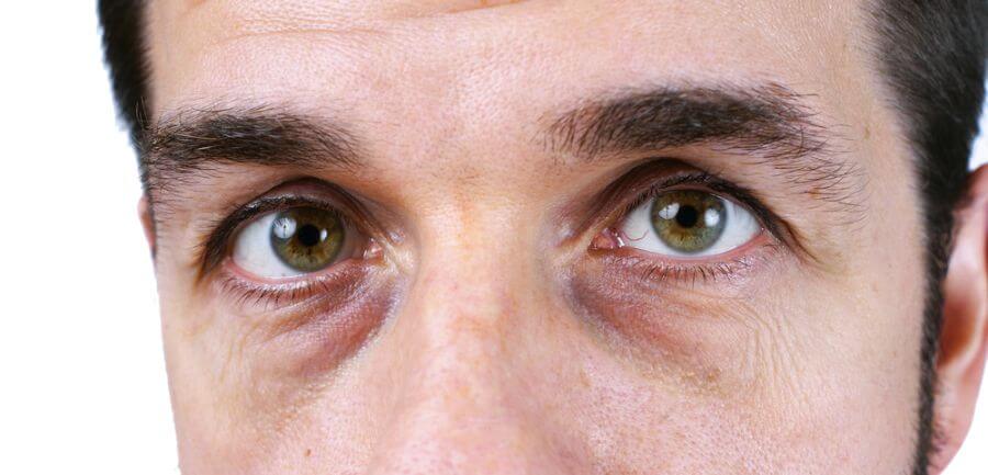 如何知道自己的是淚溝還是眼袋、黑眼圈、臥蠶?