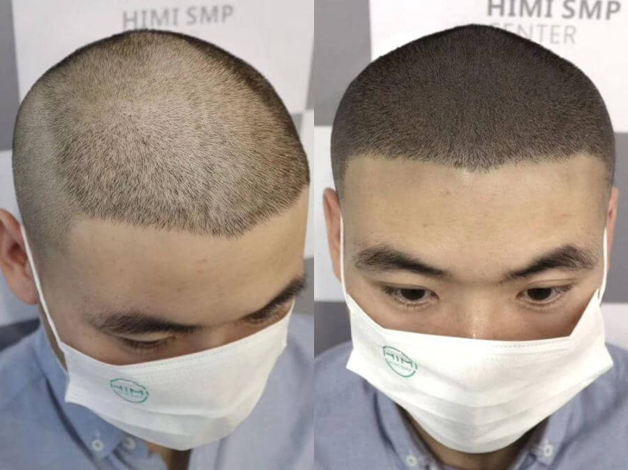 改善髮線高有甚麼方法?半永久紋髮際線是否一勞永逸?