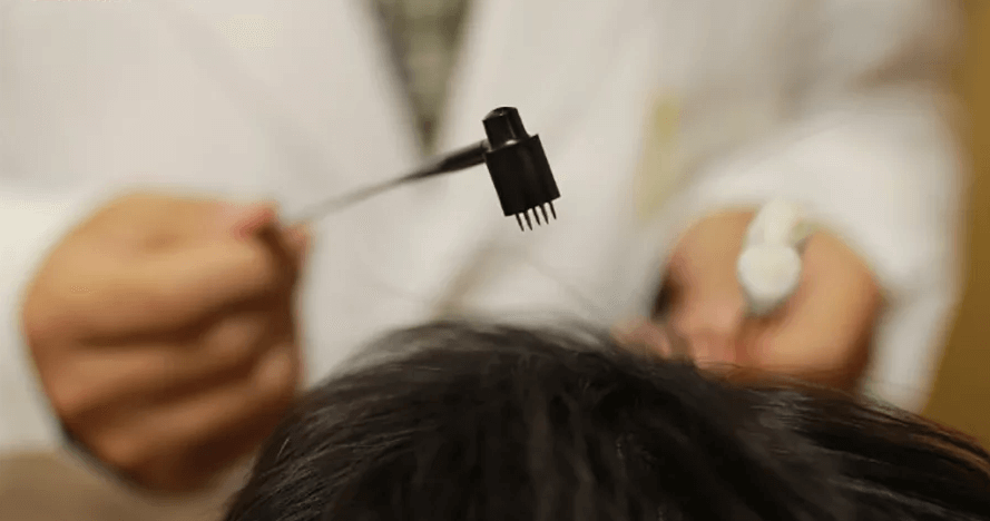 中醫的斑禿/鬼剃頭治療法