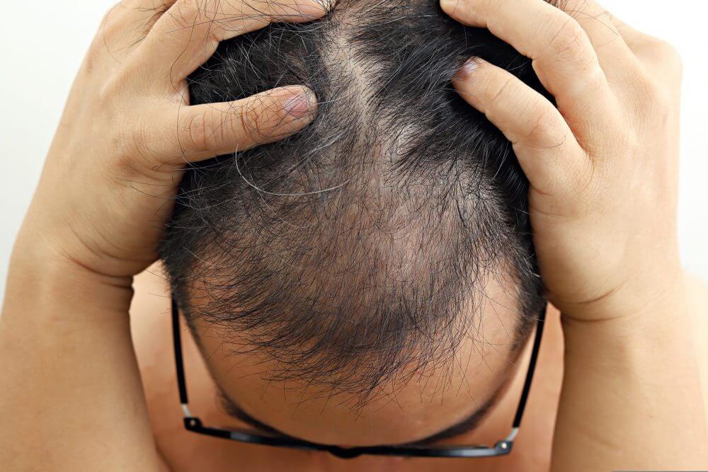 植髮改善髮際線高是最好方法?當中風險你要知道!