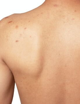 Back Acne & Scar -Before