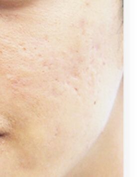 Acne Scarring-After