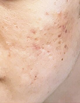 Acne Scarring-Before